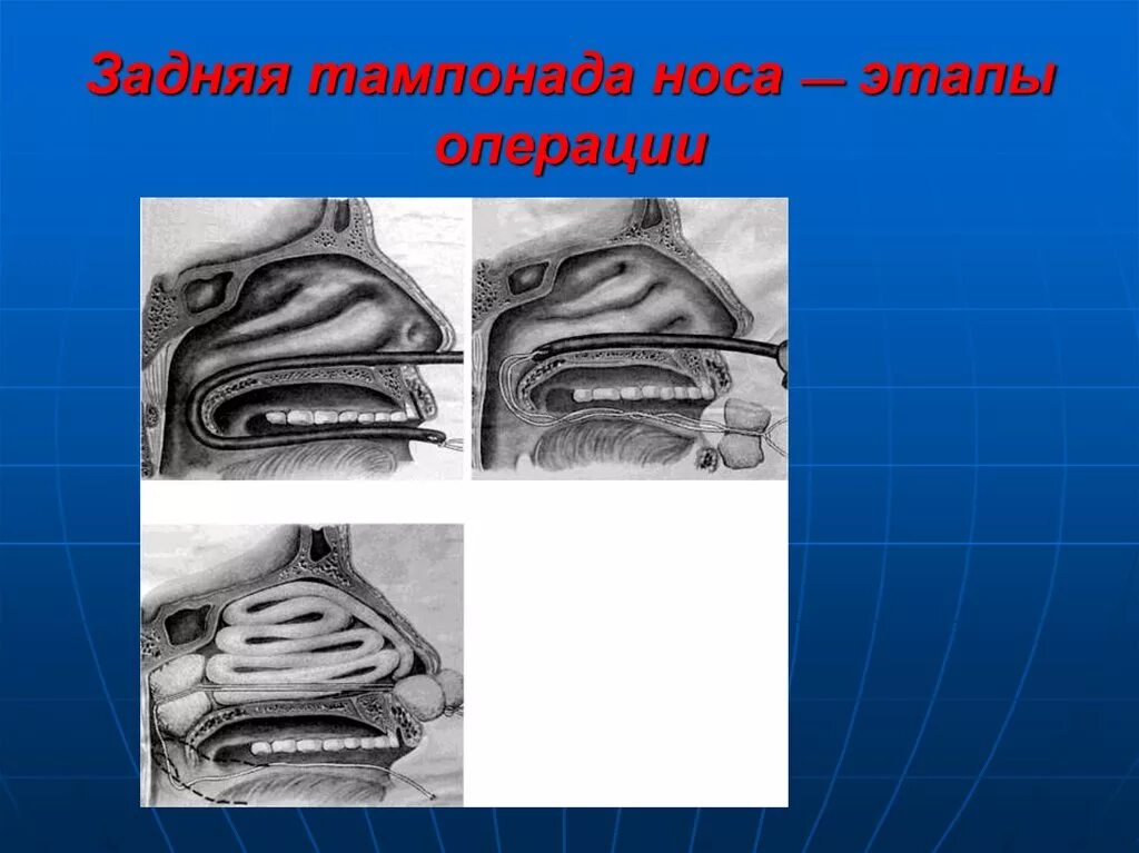 Передняя тампонада при носовом кровотечении. Задняя тампонада носа этапы. Инструменты для передней тампонады носа. Передняя тампонада носа этапы.