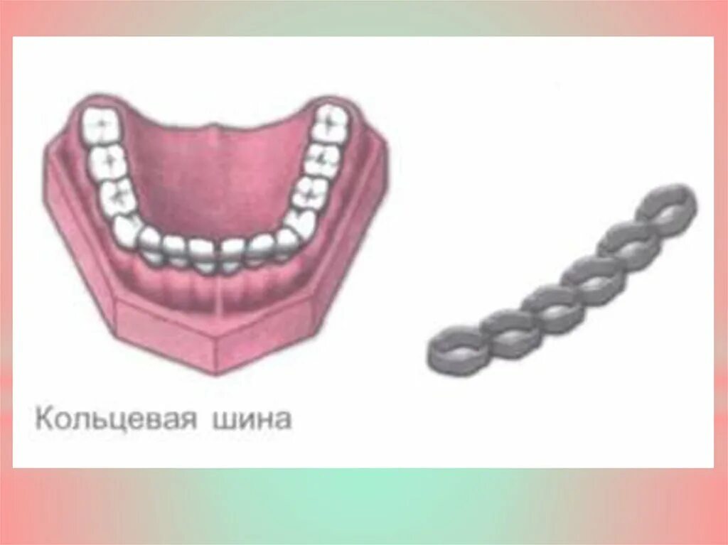 Кольцевая шина. Шинирование зубов ортопедической стоматологии. Фибер сплинт шинирование. Кольцевая шина в стоматологии. Шины в ортопедической стоматологии.