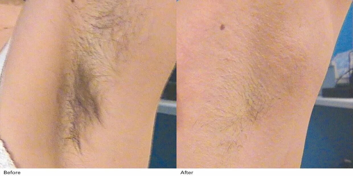 Ваксинг зоны глубокого бикини. Как часто нужно ходить на лазерную эпиляцию. Эпиляция рук до и после. Как часто нужно ходить на лазерную эпиляцию. Как часто нужно ходить на лазерную эпиляцию.