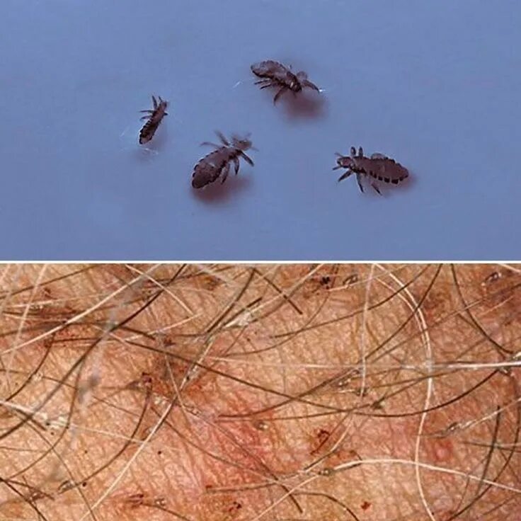 10 Bug Bites Anyone Should Be Able to Identify Bug bites, Insect bites, Bugs