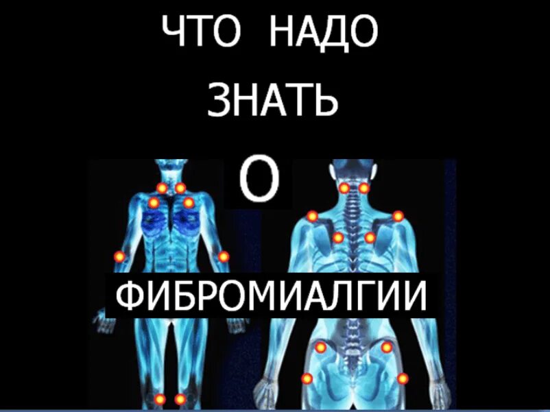 Фибромиалгия у женщин лечение после 50. Фибромиалгия. Точки боли при фибромиалгии. Болевые точки при фибромиалгии. Фибромиалгия лечится.