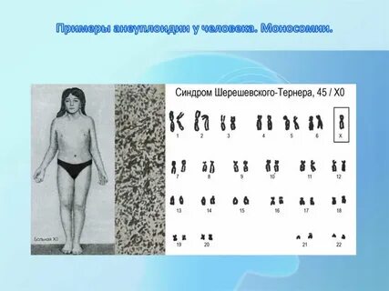 Моносомия кариотип