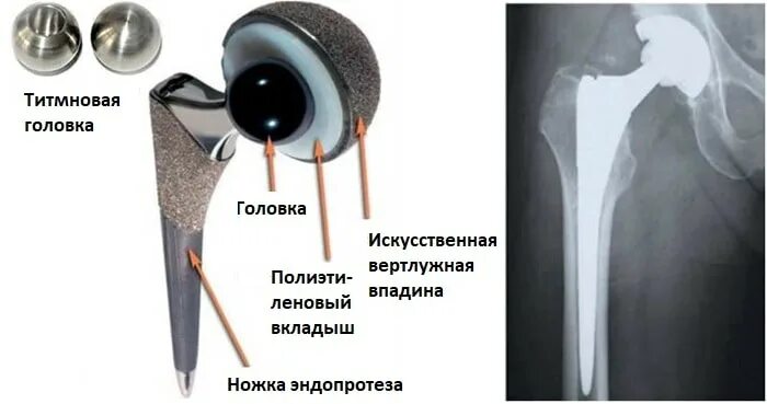 Срок службы тазобедренного эндопротеза. Перелом шейки бедра эндопротезирование тазобедренного сустава. Двухполюсное эндопротезирование тазобедренного сустава. Тазобедренный эндопротез зиммер. Тазобедренный сустав зиммер.