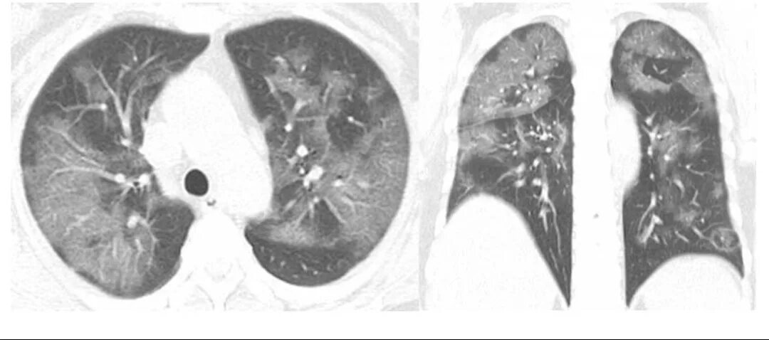 Поражение легкого 50. Кт легких пневмония коронавирус. Ковидная пневмония на кт. Коронавирус пневмония рентген. Пневмония при коронавирусе на кт.