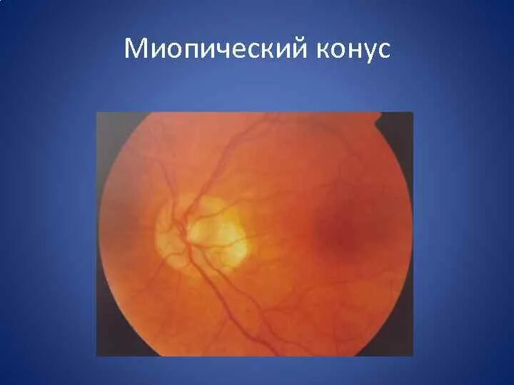 Миопический конус глазное дно. Миопическая стафилома сетчатки. Узкий миопический конус глазное дно.