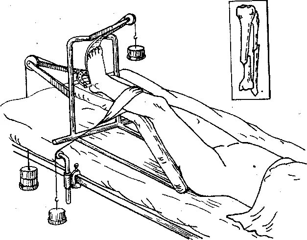Скелетное вытяжение голени