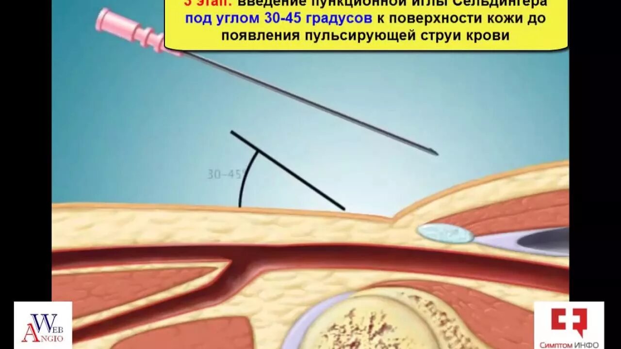 Стентирование пищевода рентген. Коронарное стентирование сосудов сердца. Коронарография пункция артерии. Стентирование коронарных артерий. Стентирование шейных артерий.