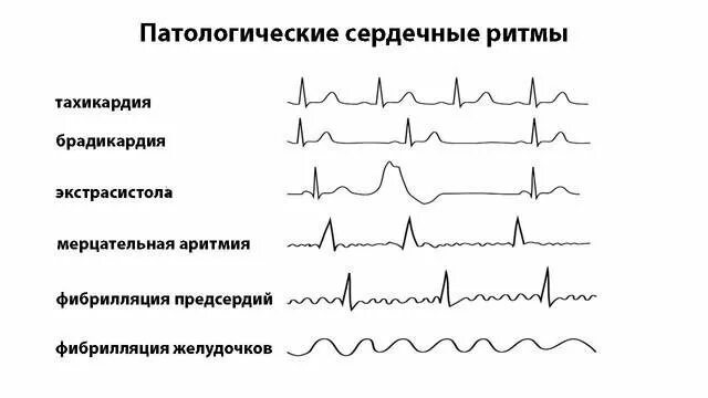 Классификация аритмий схема. Мерцательная аритмия схема ЭКГ. Классификация нарушений ритма сердца ЭКГ. Схема сердечных аритмий.