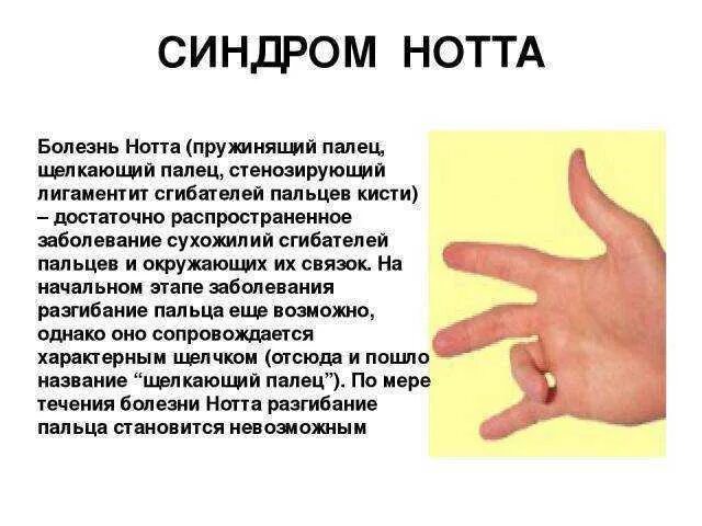 Синдром щелкающего пальца