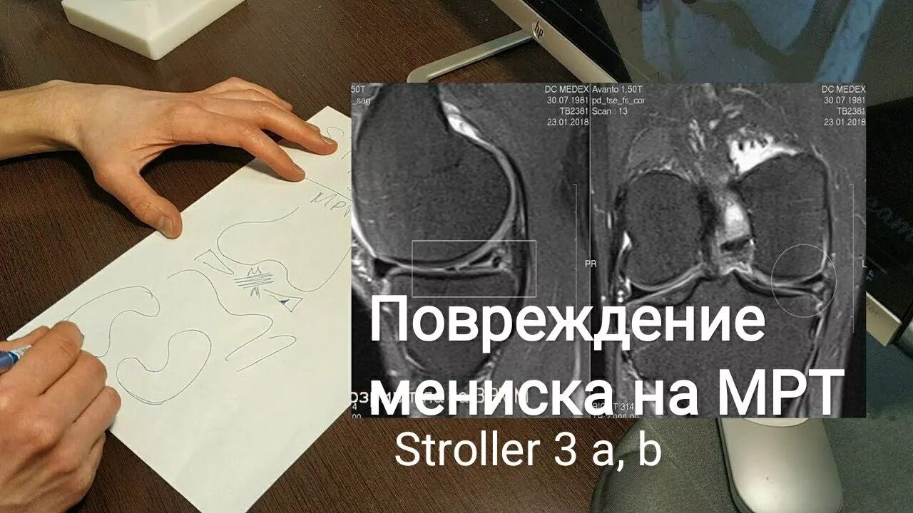 Степени повреждения менисков по Столлеру. Повреждения медиального мениска 3 b степень. Разрыв медиального мениска по Stoller. Повреждение 2 степени по Stoller.