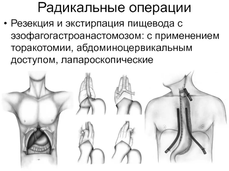 Заболевания пищевода хирургия. Операции при повреждении пищевода.