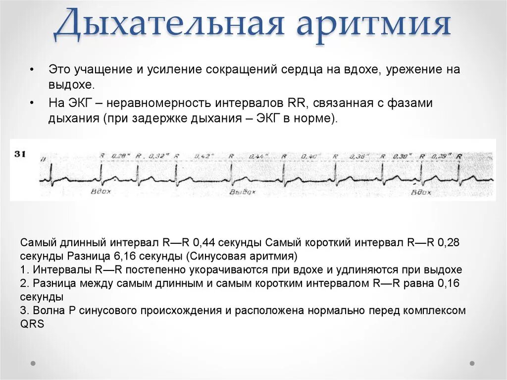 При учащении пульса длительность сердечного цикла. Синусовая дыхательная аритмия у взрослых. Синусовая дыхательная аритмия на ЭКГ. Дыхательная аритмия на ЭКГ. Синусовая аритмия дыхательная на ЭКГ причины.