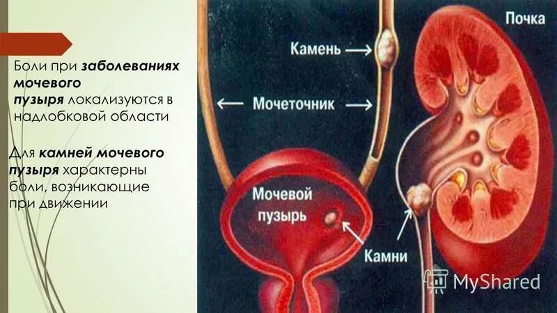 Больной мочевой. При заболевании мочевого пузыря. Болезнь мочевого пузыря название. Мочевой пузырь снаружи патология. Для заболевания мочевого пузыря характерно.