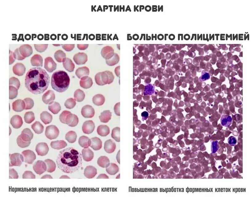 Эритроцитоз болезни