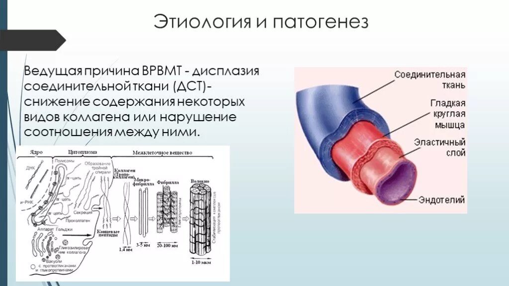 Варикоз малого таза причины. Варикоцеле этиология и патогенез. Патогенез дисплазии соединительной ткани.