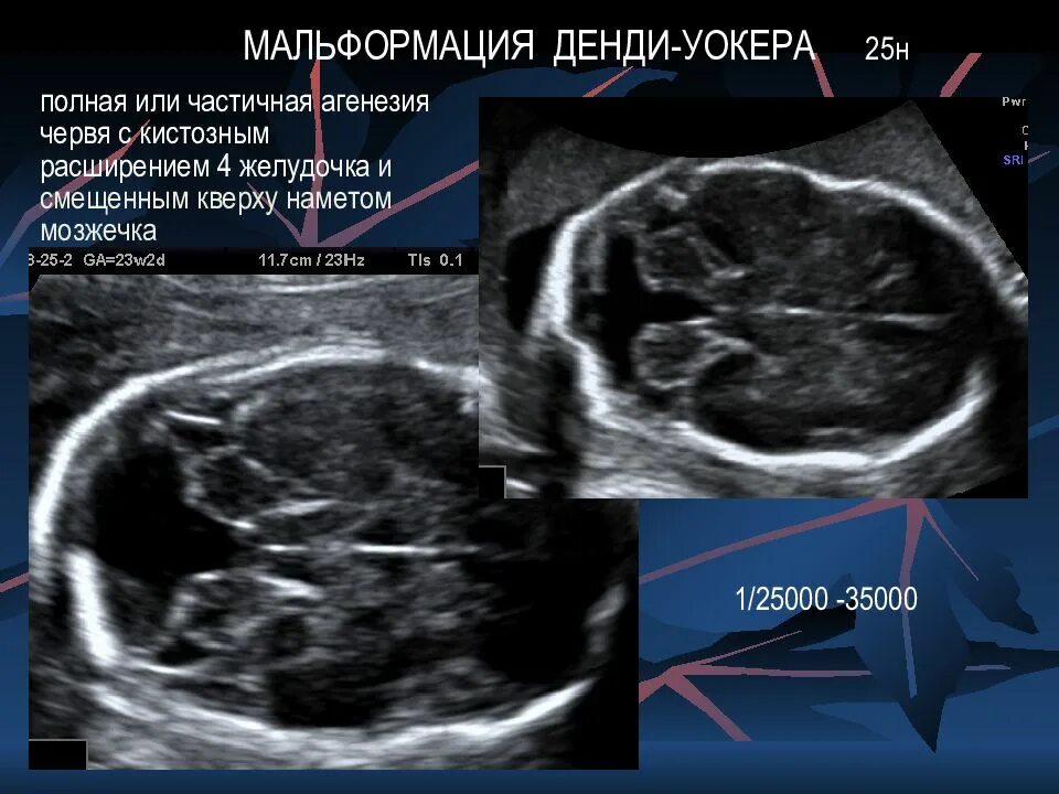 Гипоплазия червя. Гипоплазия червя мозжечка у плода на УЗИ. Денди-Уокера аномалия УЗИ плода. Синдром Денди Уокера на УЗИ. Денди Уокера у плода УЗИ.