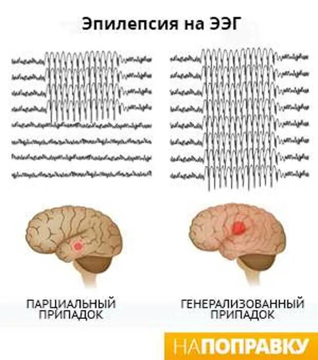 Эпи ээг. ЭЭГ В норме и при эпилепсии. ЭЭГ здорового человека и эпилептика. ЭЭГ при фокальной эпилепсии. Эпилептический признак на ЭЭГ.