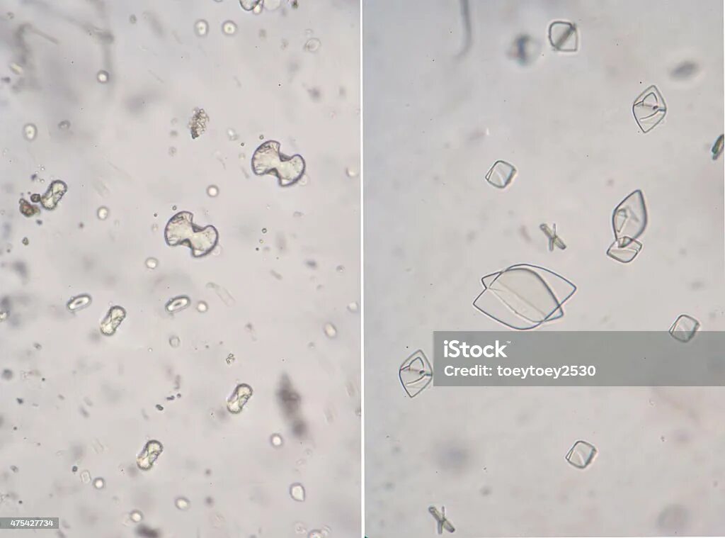 Углекислый кальций в моче микроскопия. Оксалаты микроскопия мочи. Оксалаты микроскопия мочи. Кристаллы кальция в моче. Оксалаты кальция в моче микроскоп.