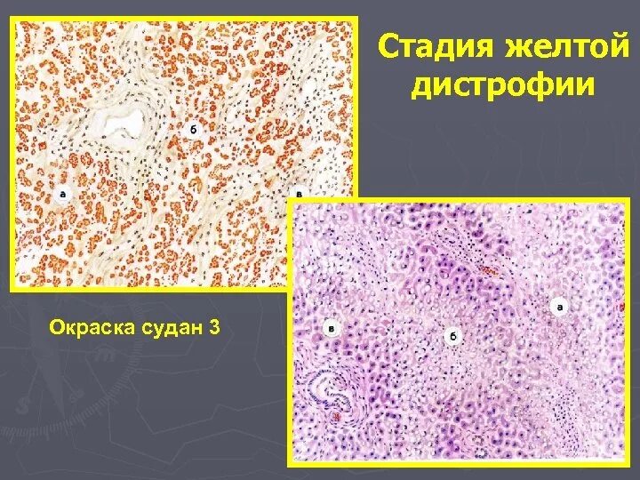 Токсическая дистрофия печени. Жировая дистрофия печени микропрепарат Судан 3. Жировая дистрофия печени окраска Суданом 3. Токсическая дистрофия печени препарат. Токсическая дистрофия печени Судан 3.