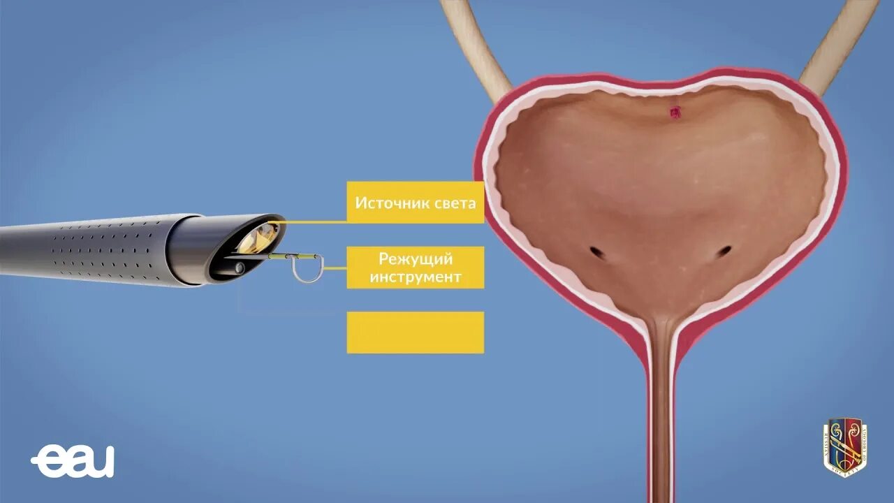 Трансуретральная биопсия предстательной железы. Трансуретральная резекция уретры. Тур опухоли мочевого пузыря. En-bloc резекция мочевого пузыря. Удаление мочевого пузыря при раке