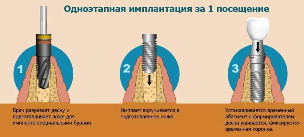 Через сколько после установки коронки можно есть