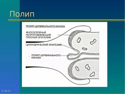 Анализ полипы матки