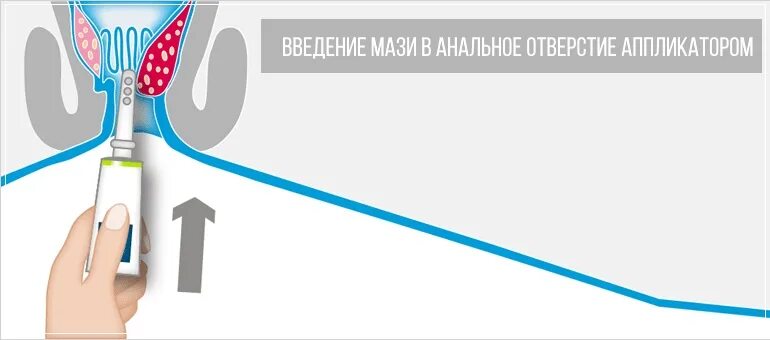 Как использовать мазь с аппликатором. Что такое аппликатор для ректальной мази. Аппликатор для введения мази в прямую кишку. Мазь от геморроя с аппликатором. На какую глубину вводят ректальную свечу