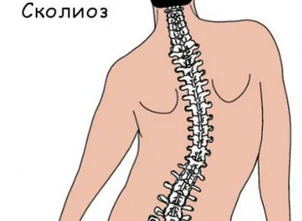 Инфантильный сколиоз это