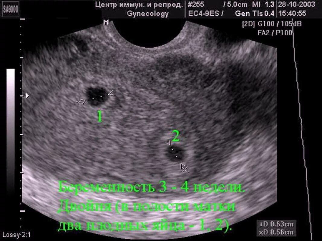 УЗИ на 5 неделе беременности двойня. УЗИ беременность 2 плодных яйца. УЗИ 3 недели беременности двойня. Как выглядит эмбрион в 5-6 недель на УЗИ. На узи видно месячные
