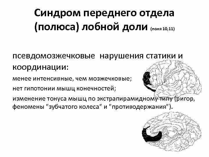 Синдромы поражения лобной доли. Синдром лобной доли клинические проявления. синдром поражения лобных отделов. нарушения личности при поражении лобной доли..