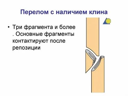 Признаки клина