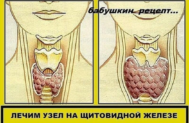 Как вылечить узлы. Узлы в щитовидной железе. лечить узел на щитовидной железе что.
