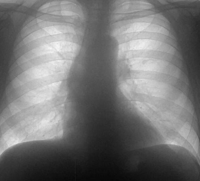Лёгкие после пневмонии. Нормальная работа легких. Нормальная работа легких. Легкие рентген норма. Снимок лёгких здорового.