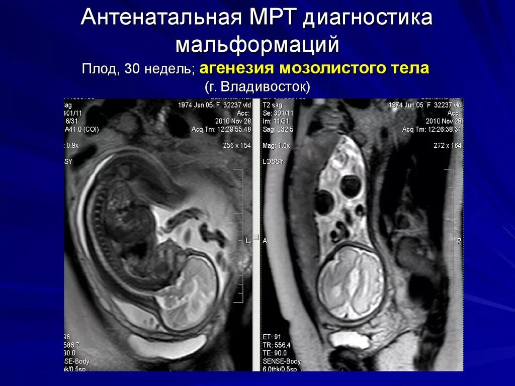 Пренатальная диагностика узи. Внутриутробная диагностика плода. Внутриутробная диагностика плода. Классификация методов исследования состояния плода. Ультразвуковое исследование пренатальная диагностика.