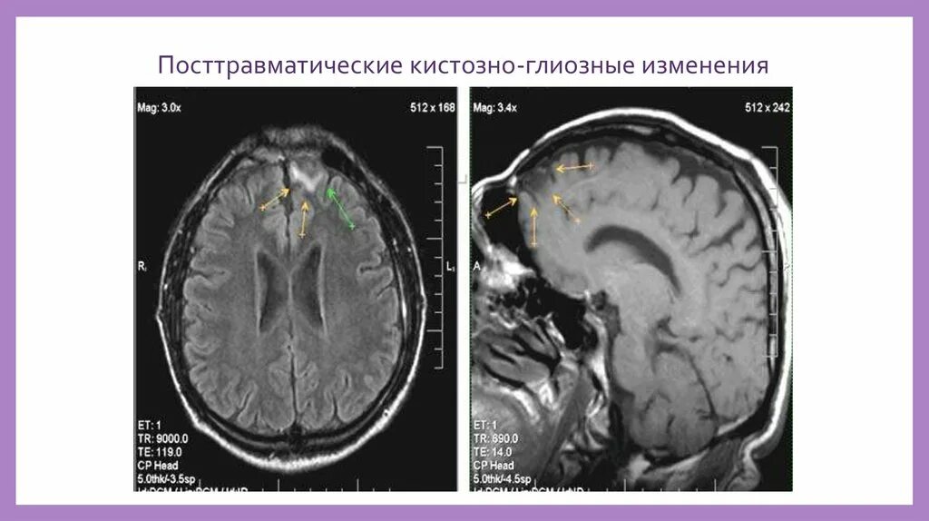 Глиозные изменения лобной доли