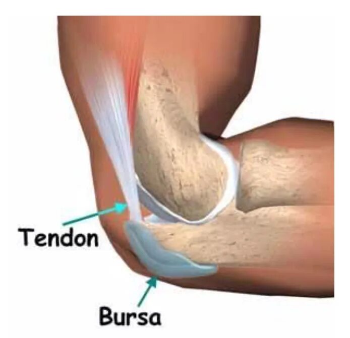 Травма Бурсы локтевого сустава. Шишка бурсит локтевого сустава.