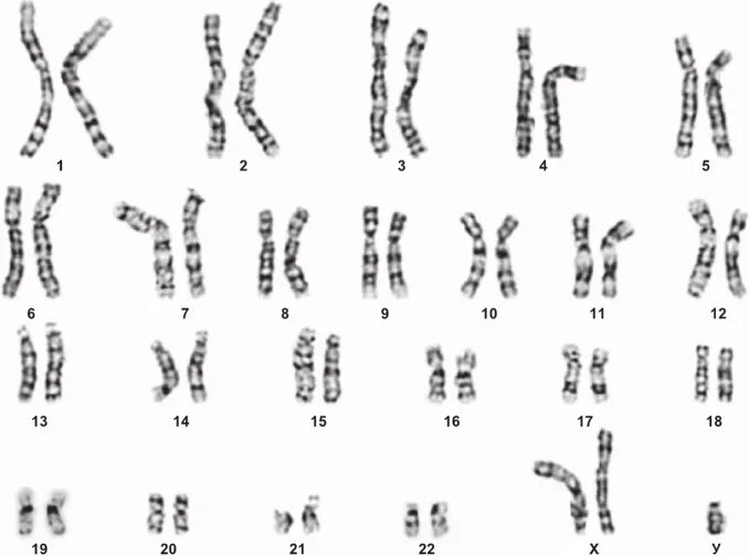 Половые хромосомные заболевания. Синдром Варкани кариотип. Числовые аномалии половых хромосом (синдром Тернера, Клайнфельтера). Цитогенетические аномалии половых хромосом. Аномалии хромосомные по половым хромосомам.