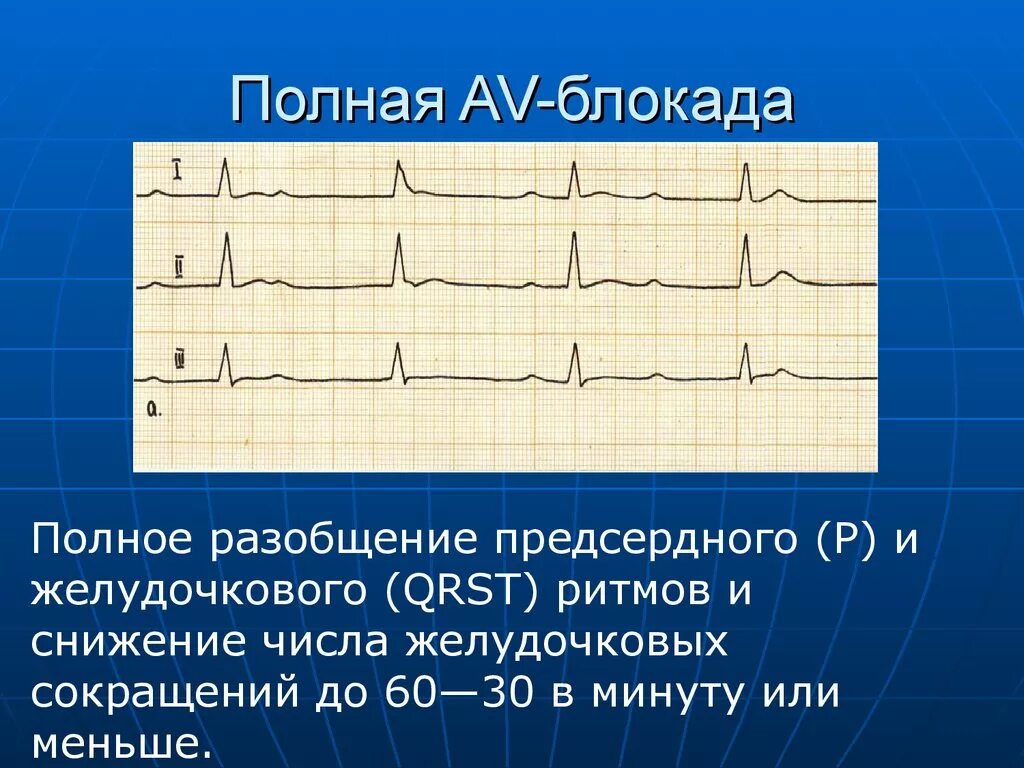 Полная АВ блокада на ЭКГ. Полная АВ блокада 3 степени ЭКГ. ЭКГ av блокады на ЭКГ. Полная av блокада на ЭКГ. Fuller av