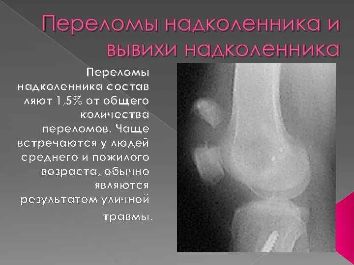 Подвывих надколенника рентген. Подкапсульный перелом надколенника. Надколенник коленного сустава перелом. Перелом вывих надколенника. Перелом надколенника операции