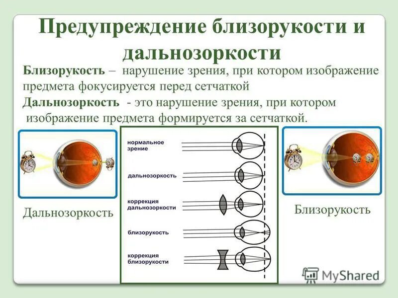 Причины и профилактика близорукости и дальнозоркости. Зрительный анализатор дальнозоркость и близорукость. Профилактика близорукости и дальнозоркости. Таблица нарушение зрения близорукость дальнозоркость. Миша страдает близорукостью а его брат дальнозоркостью