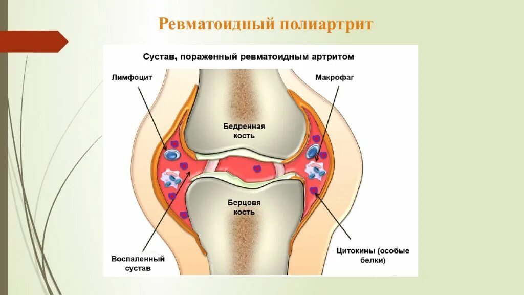 Ревматоидный полиартрит. Суставы при ревматоидном артрите. Ревматический полиартрит. Поражение суставов при ревматоидном артрите. Ревматоидный артрит легких