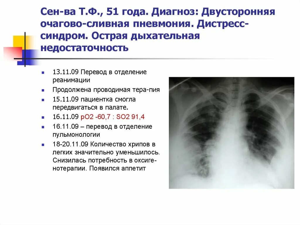 Лечение поражения легких. Двусторонняя пневмония симптомы. Двухстороннее воспаление лёгких. Двустороннее воспаление легких симптомы. Двусторонняя пневмония легкие.