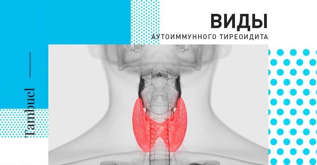 Аутоиммунный тиреоидит. Аутоиммунные заболевания щитовидной железы. Аутоиммунный тиреоидит зоб Хашимото. Симптомы аутоиммунного тиреоидита.