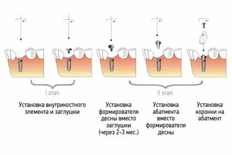 Через сколько после имплантации