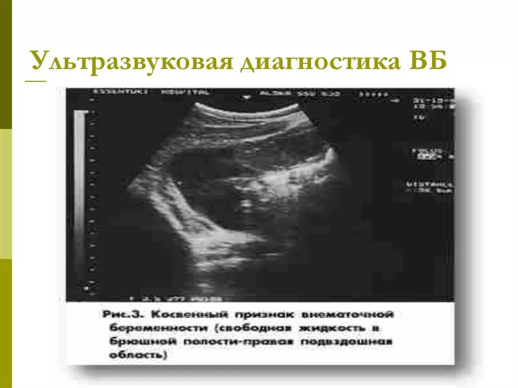 Диагноз внематочная беременность. Ультразвуковая диагностика внематочной беременности. Брюшная беременность УЗИ. Трубная беременность УЗИ. Внематочная беременность на УЗИ.