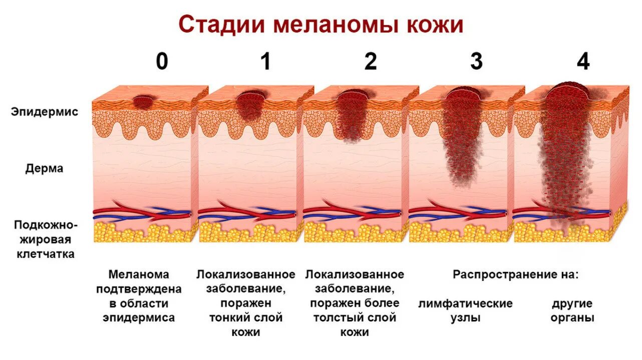Первая стадия. Меланоцитарная меланома. Стадии развития меланомы. Меланома строение кожи.