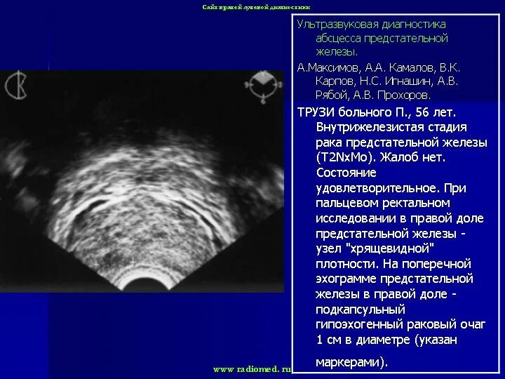 Дгпж узи. УЗИ предстательной железы Изранов. УЗИ простаты заключение норма. Протокол УЗИ нормальной предстательной железы. Предстательная железа на трансабдоминальном УЗИ.