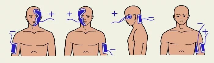 Брома на воротниковую зону. Электрофорез методики наложения электродов. Электрофорез по Бергонье методика. Гальванический воротник по Щербаку места наложения электродов. Гальванизация воротниковой зоны по Щербаку.
