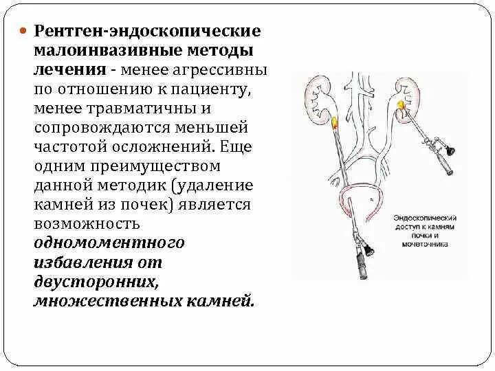 Мочекаменная болезнь эндоскопические методы. Эндоскопические методы лечения мочекаменной болезни. Малоинвазивные методы лечения. Миниинвазивные методы лечения это. Резекция почки что это