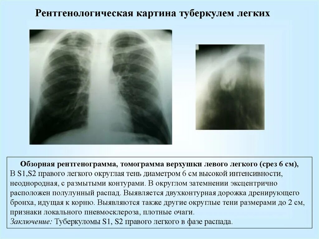 Без очаговых и инфильтративных изменений. Казеозная пневмония рентгенограмма. Туберкулез туберкулема. Инфильтративный туберкулёз лёгких рентген. Очаговый и инфильтративный туберкулез.